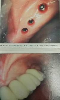 Experte Zahnimplantate Berlin Dr. Stoltenburg M.Sc., M.Sc., MPI / T&auml;ti